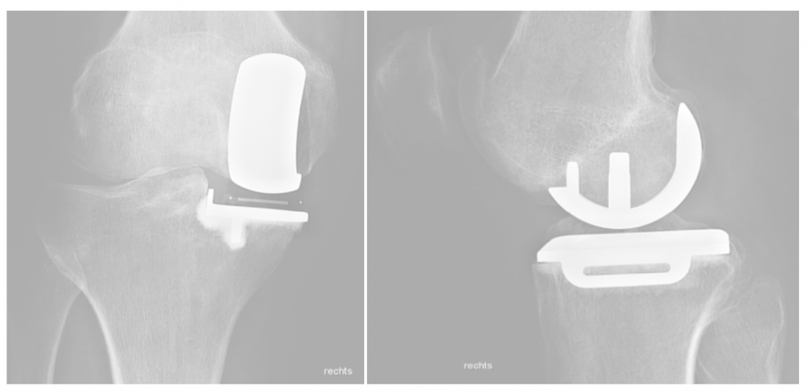 Teilgelenkersatz Knie